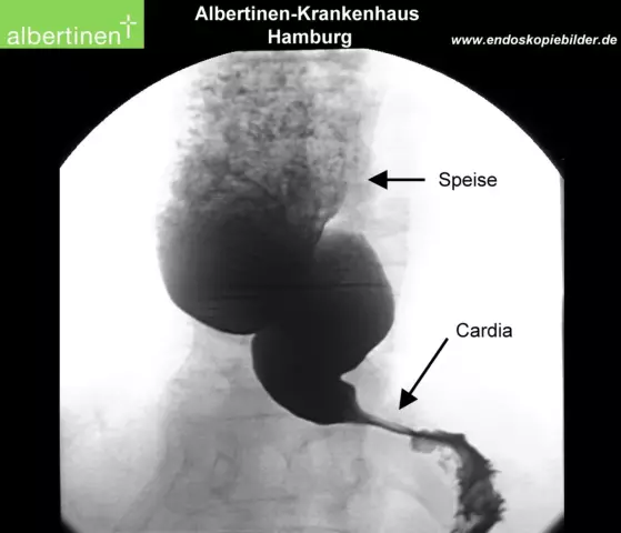 Achalasia In Psi