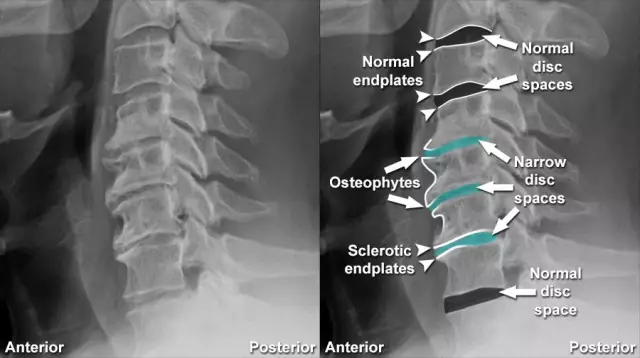 Discopathie dégénérative canine vs. Rupture du disque