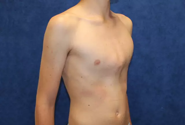 Pectus Carinatum chez le chien