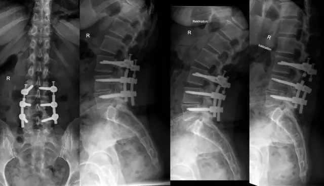 Lumbosacral ασταθής σε σκύλους